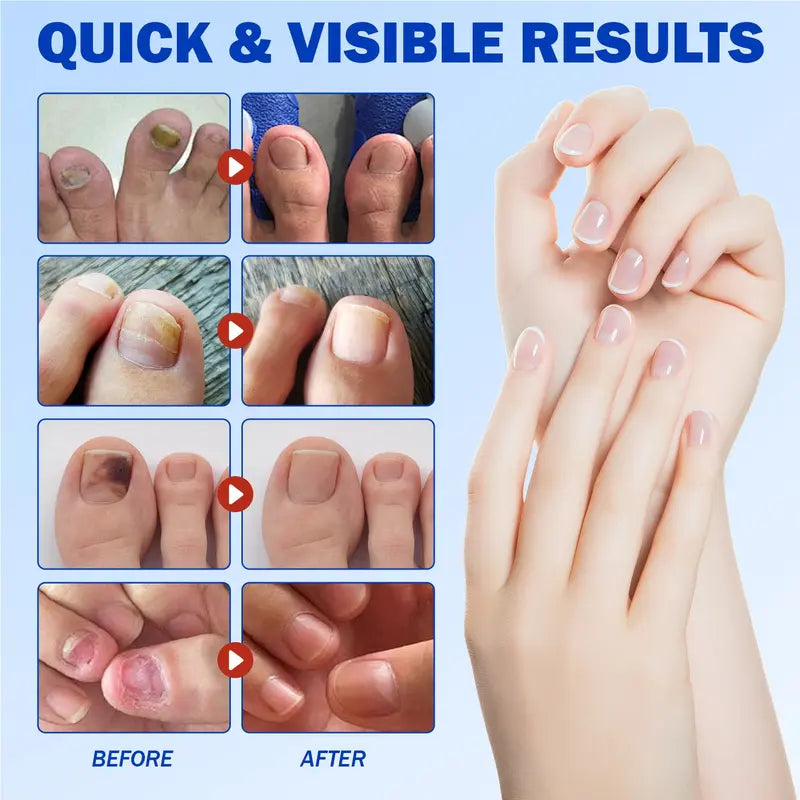 Up to 65% OFF!๐ฅNail Health Care Patches โ Repair and Strengthen Weak Nails